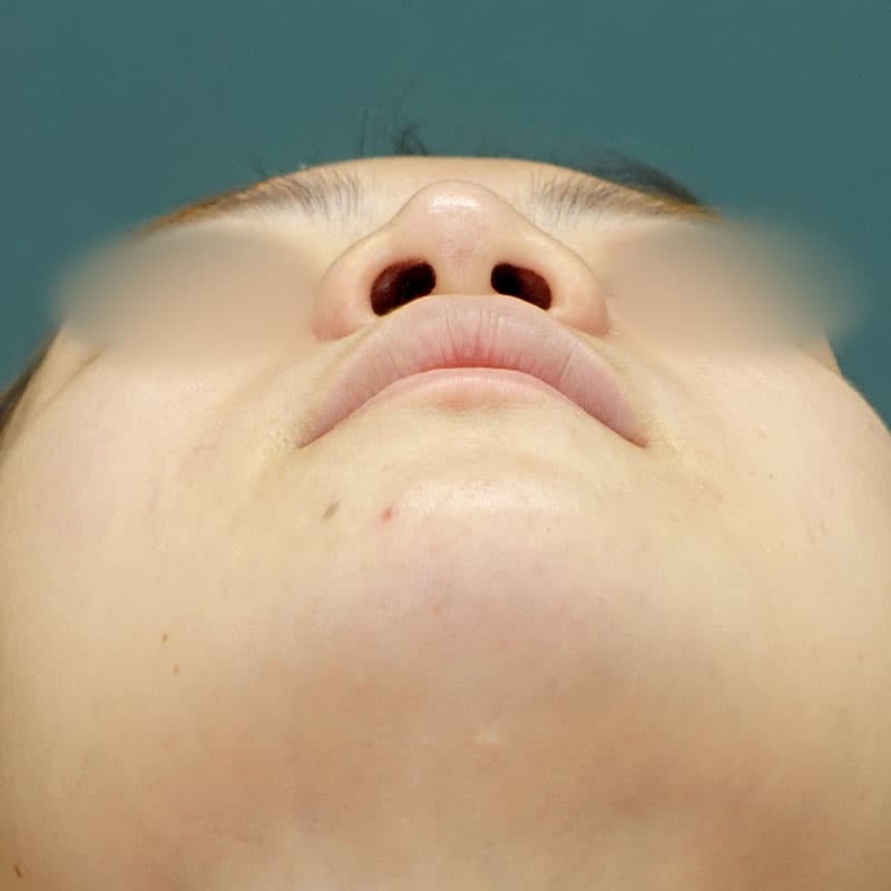 20261006_N165092_morishima_nostril reduction ①Before