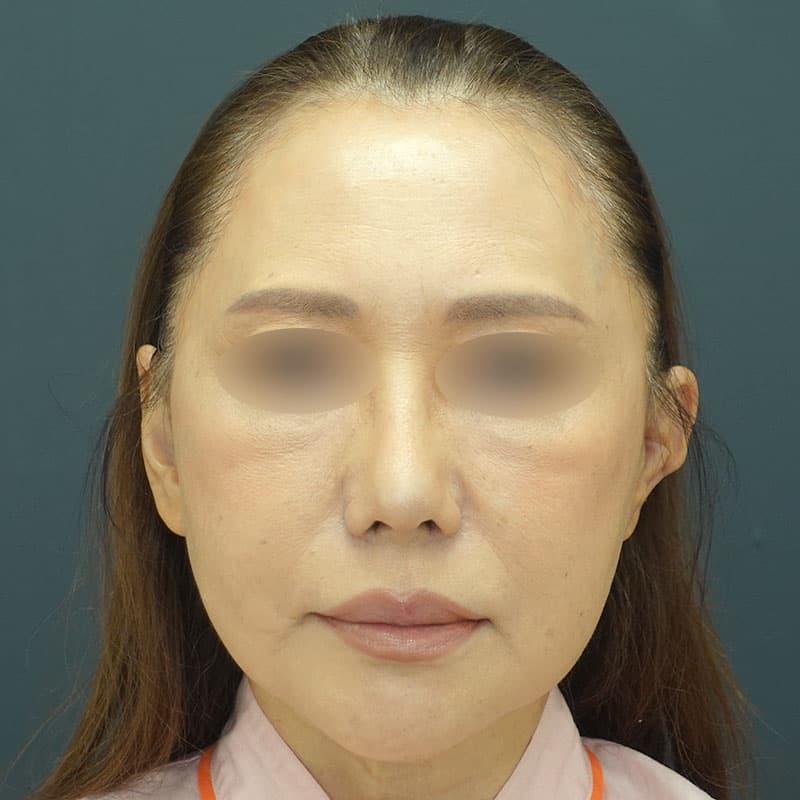 20261009_N158280_morishima_nostril reduction ①After