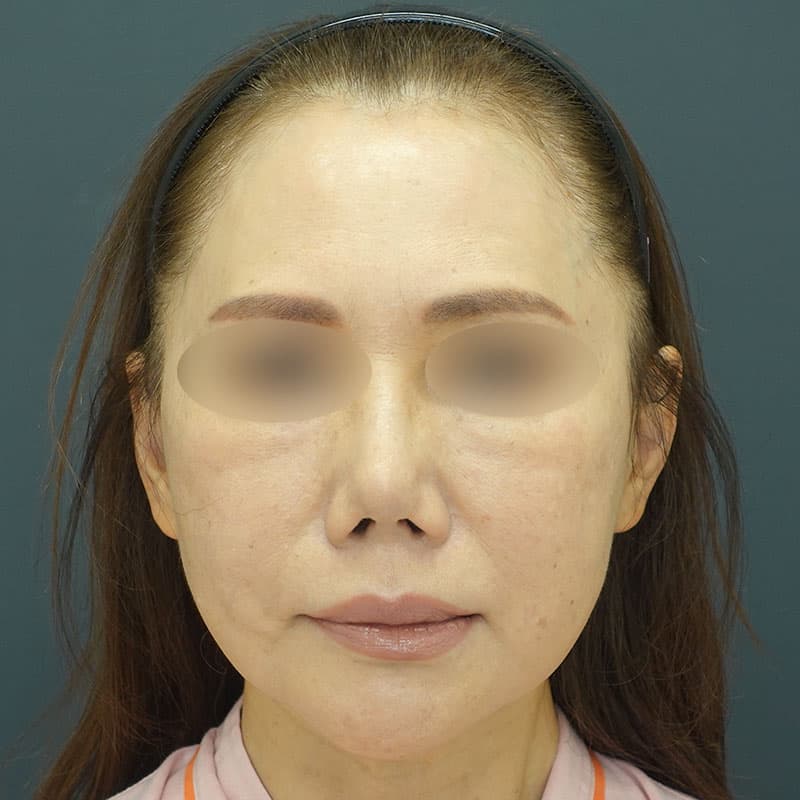 20261009_N158280_morishima_nostril reduction ①Before