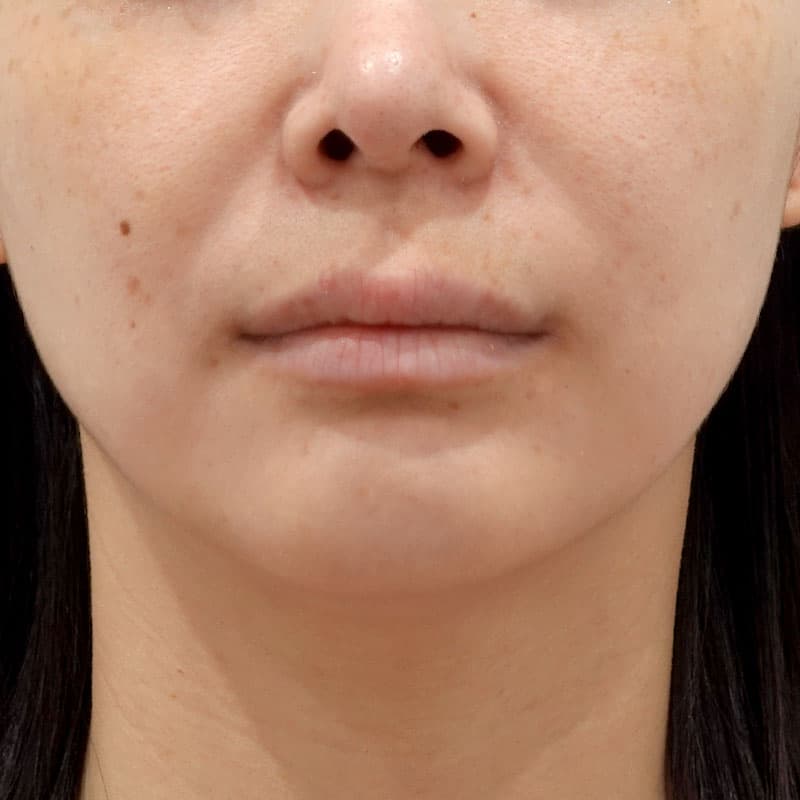 20261015_G143380_tokiwa_hyaluronic nasolabial folds①After