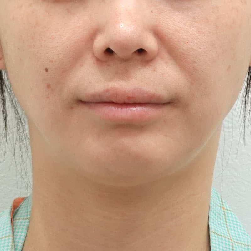20261015_G143380_tokiwa_hyaluronic nasolabial folds①Before