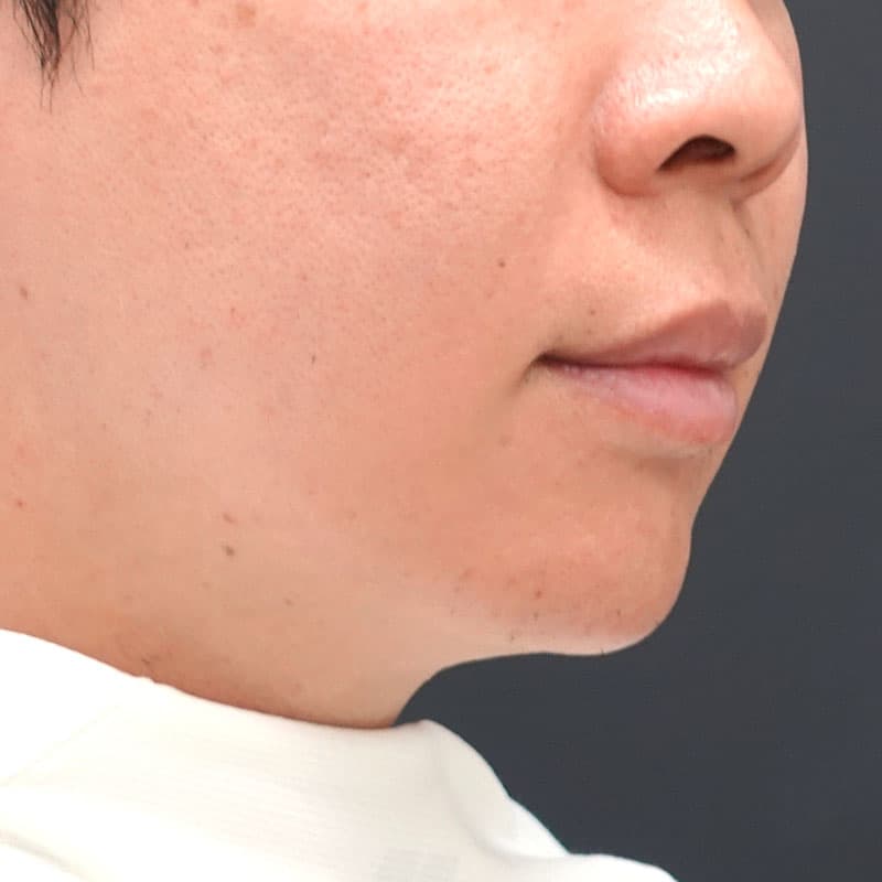 20261026_st20261026-2_sugishima_hyaluronic nasolabial folds ①After