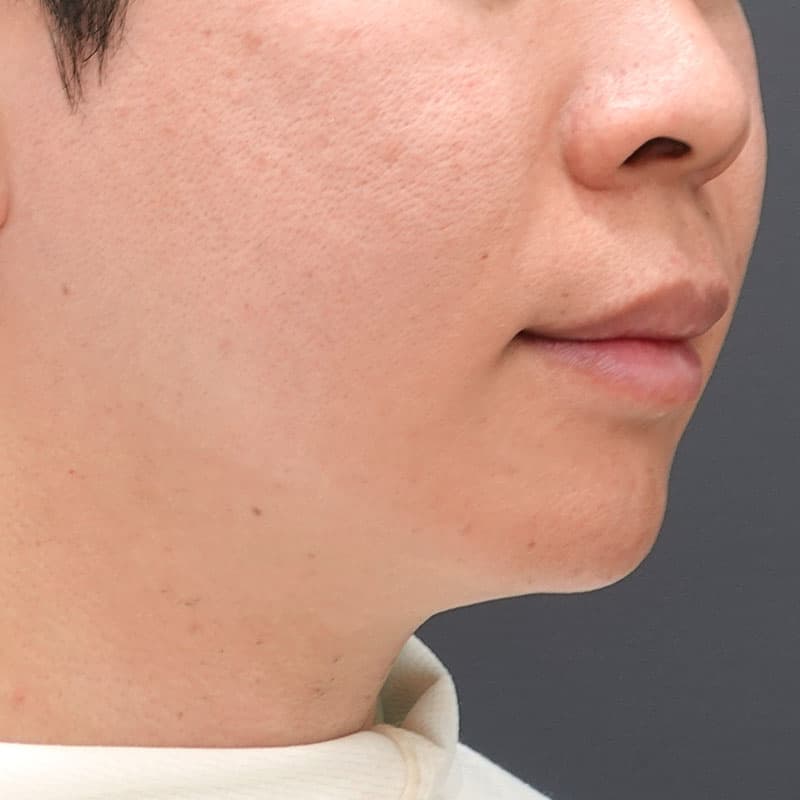 20261026_st20261026-2_sugishima_hyaluronic nasolabial folds ①Before