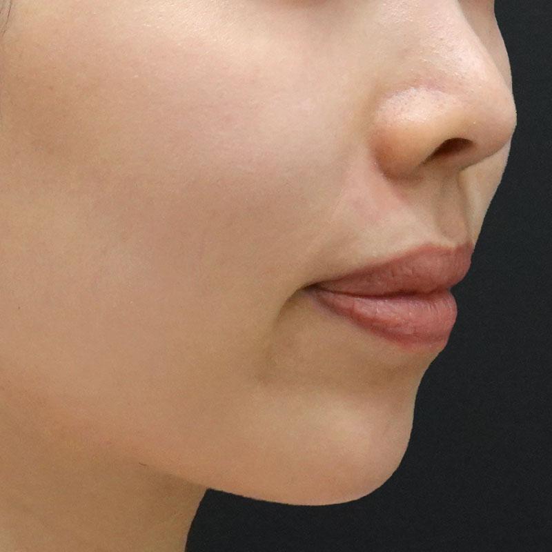 20261029_st20261029_hyaluronic nasolabial folds ①After