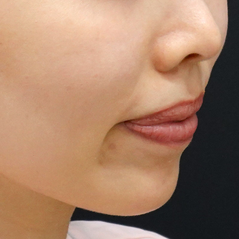 20261029_st20261029_hyaluronic nasolabial folds ①Before